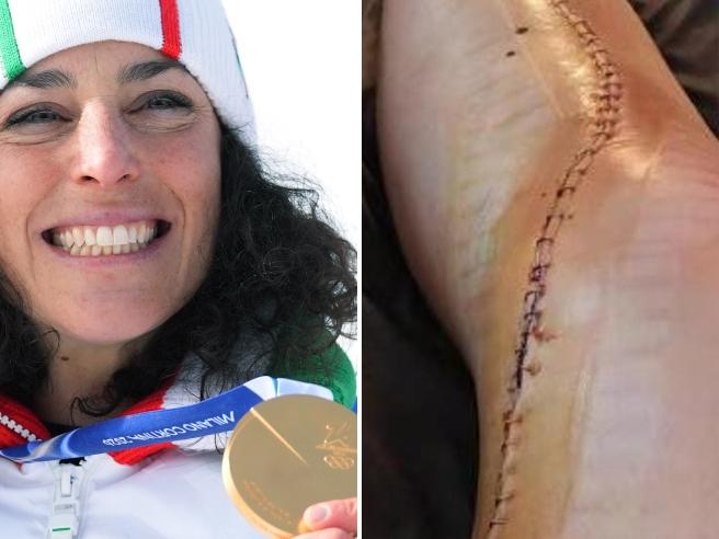 brignone ginocchio operato