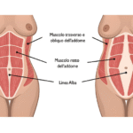 Diastasi addominale
