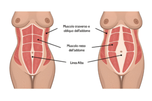 Diastasi addominale