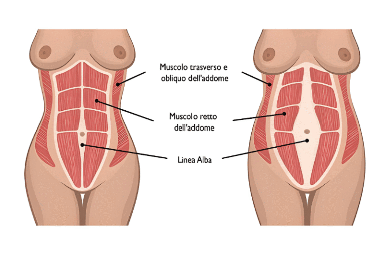 Diastasi addominale