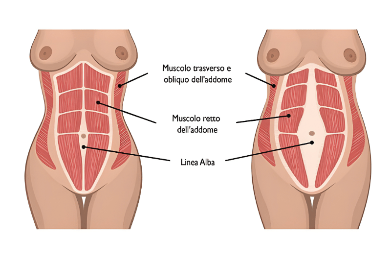 Diastasi addominale